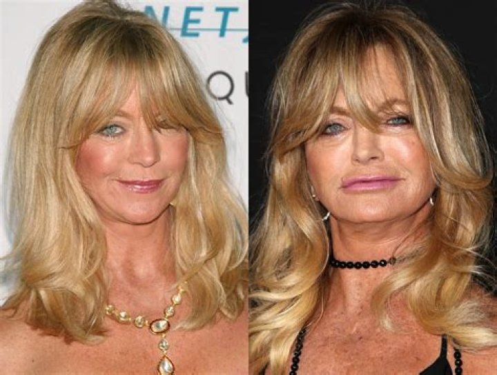 Unveiling The Charm: Goldie Hawn Before Plastic Surgery