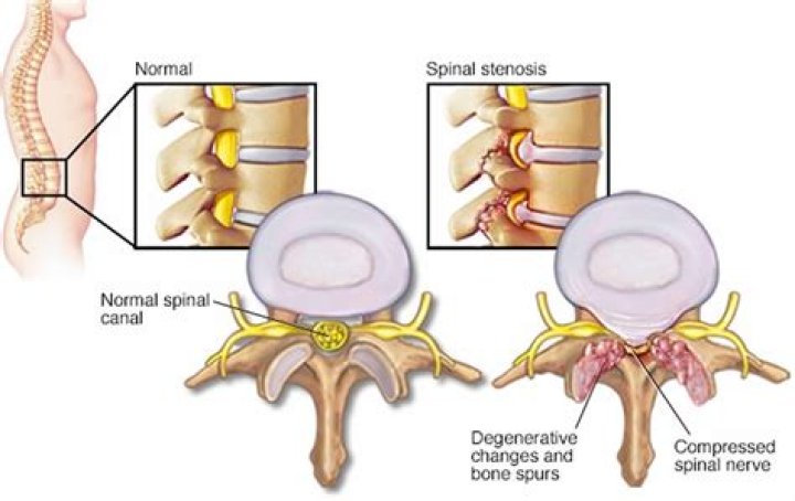 Understanding Spinal Stenosis Through The Lens Of Cooper Manning
